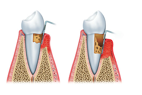 Ventajas del tratamiento periodontal