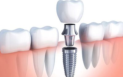 Mantenimiento de los implantes dentales