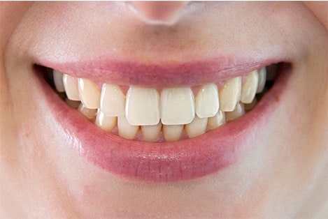 ¿Qué dice la forma de tus dientes sobre tu personalidad?