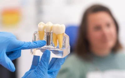 Implantes dentales: qué esperar antes, durante y después del tratamiento