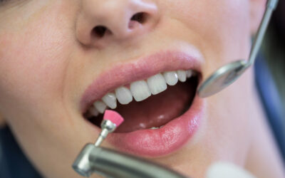 Blanqueamiento dental: tipos, resultados y cuidados