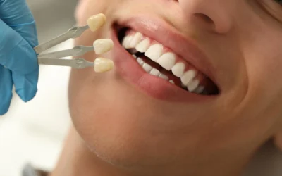 Carillas dentales: ventajas, mantenimiento y diferencias